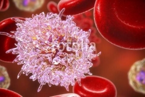 Phát hiện biến thể gene hiếm giúp giảm nguy cơ ung thư máu