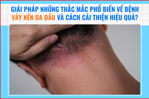 Giải đáp những thắc mắc phổ biến về bệnh vảy nến da đầu và cách cải thiện hiệu quả