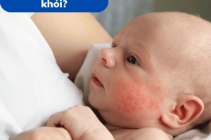 Bé bị viêm da: Chăm sóc thế nào để mau khỏi?