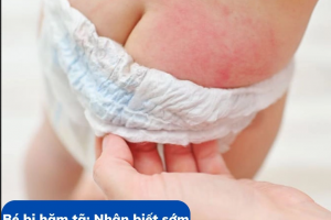 Bé bị hăm tã: Nhận biết sớm và chăm sóc đúng cách để da nhanh hồi phục