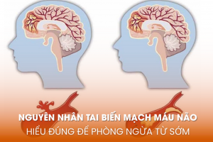 Nguyên nhân tai biến mạch máu não: Hiểu đúng để phòng ngừa từ sớm