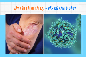 Vảy nến tái đi tái lại - Vấn đề nằm ở đâu?