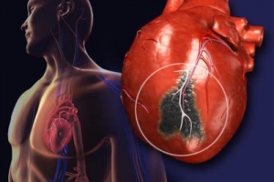 Lối sống tĩnh tại: "Sát thủ" âm thầm đe dọa trái tim và mạch máu