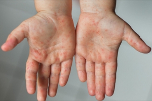 Lào Cai tăng cường phòng, chống bệnh tay chân miệng và các bệnh truyền nhiễm