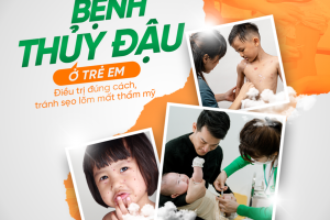 Thủy đậu không phải là bệnh lành tính và nguy cơ biến chứng nghiêm trọng ở trẻ em