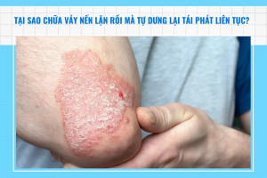 Vì sao vảy nến đã thuyên giảm nhưng vẫn tái phát?