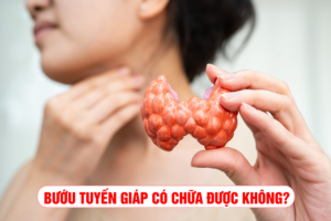 Bướu tuyến giáp có chữa được không? 