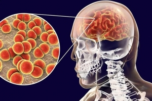 Báo động số ca mắc não mô cầu tăng mạnh, chuyên gia cảnh báo chuỗi di chứng nặng nề