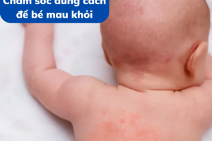 Rôm sảy trẻ nhỏ: Chăm sóc đúng cách để bé mau khỏi