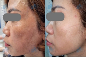Bác sĩ da liễu lý giải vì sao nhiều người trị nám tốn kém nhưng vẫn tái phát