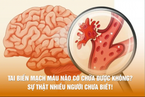 Tai biến mạch máu não có chữa được không? Sự thật nhiều người chưa biết