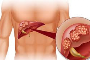 Hiểm họa ung thư gan từ sự lơ là với virus viêm gan B
