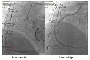Cần Thơ: Cứu sống một bệnh nhân suy tim cấp bằng 4 stent tái thông hoàn toàn hệ mạch vành