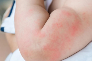Trẻ bị viêm da: Những điều cha mẹ cần biết