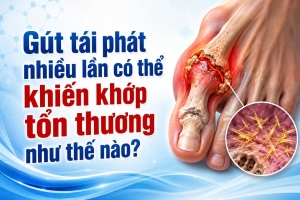 Gút tái phát nhiều lần có thể khiến khớp tổn thương như thế nào?