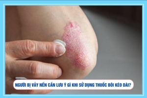 Người bị vảy nến cần lưu ý gì khi sử dụng thuốc bôi kéo dài?