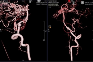 Bệnh viện Đa khoa Quốc tế S.I.S Cần Thơ: Cứu sống bệnh nhân hôn mê sâu do vỡ túi phình động mạch đốt sống