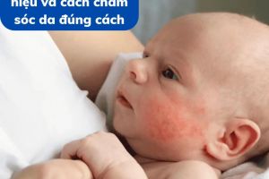 Rôm sảy ở bé: Nguyên nhân, dấu hiệu và cách chăm sóc da đúng cách