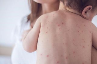 Cảnh báo về dịch đậu mùa khỉ: Số ca mắc bệnh ở Israel lên đến hơn 200 người