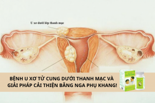  U xơ tử cung dưới thanh mạc và giải pháp cải thiện bằng Nga Phụ Khang