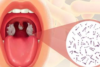 Biến chứng nguy hiểm của bệnh bạch hầu