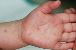 Sở Y tế tỉnh Thanh Hóa ban hành công văn tăng cường công tác phòng, chống bệnh tay chân miệng