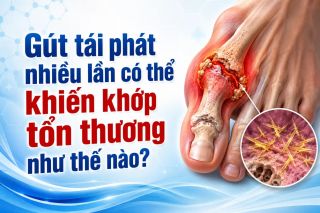 Gút tái phát nhiều lần có thể khiến khớp tổn thương như thế nào?