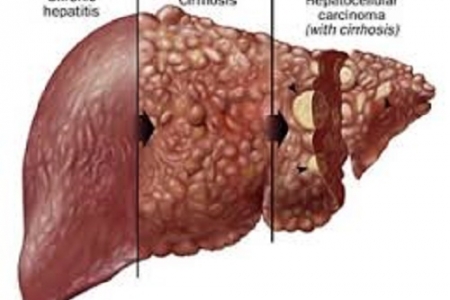 Viêm gan: nguyên nhân lớn nhất gây ung thư gan, xơ gan