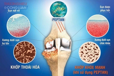 Những khó khăn trong điều trị bệnh xương khớp