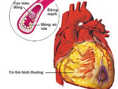 Hút thuốc lá là nguyên nhân hàng đầu gây ra bệnh lý tim mạch