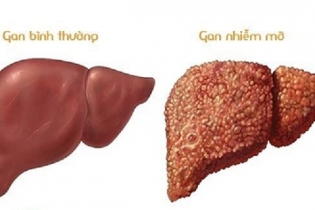 Nguy cơ bị gan nhiễm mỡ từ 6 loại thực phẩm