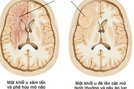 Những dấu hiệu và triệu chứng cảnh báo bệnh u não