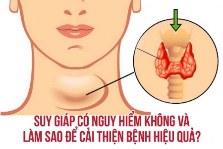 Suy giáp có nguy hiểm không và làm sao để điều trị bệnh hiệu quả?