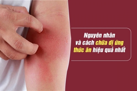 Nguyên nhân và cách chữa dị ứng thức ăn hiệu quả nhất