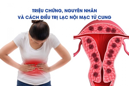 Triệu chứng, nguyên nhân và cách điều trị lạc nội mạc tử cung