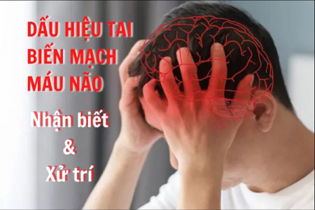 Dấu hiệu tai biến mạch máu não - Cách nhận biết và xử trí