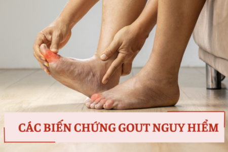 Cảnh báo 3 biến chứng gout nguy hiểm và cách phòng ngừa từ Hoàng Thống Phong