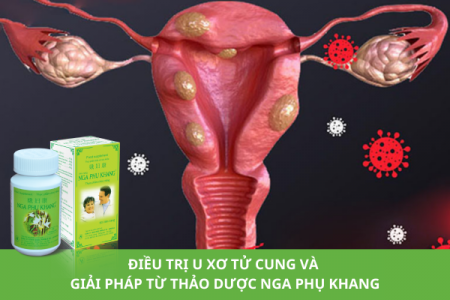 Tổng hợp cách điều trị u xơ tử cung và giải pháp cải thiện nhờ Nga Phụ Khang