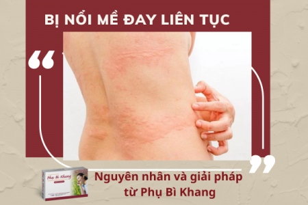 Bị nổi mề đay liên tục: Nguyên nhân và giải pháp từ Phụ Bì Khang