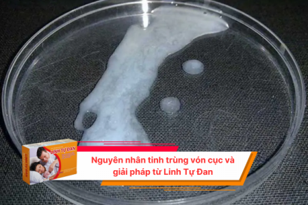 Nguyên nhân tinh trùng vón cục và giải pháp từ Linh Tự Đan