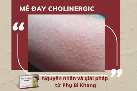 Mề đay cholinergic: Nguyên nhân và giải pháp từ Phụ Bì Khang