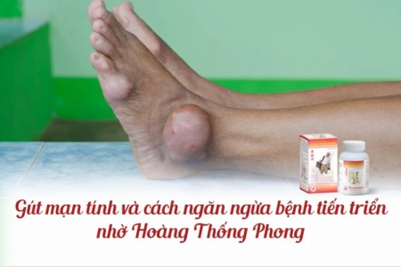 Gút mạn tính và cách ngăn ngừa bệnh tiến triển nhờ Hoàng Thống Phong