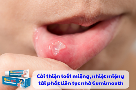 Cải thiện loét miệng, nhiệt miệng tái phát liên tục nhờ Gumimouth