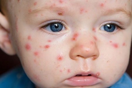 Hà Nội xuất hiện ca mắc Rubella đầu tiên trong năm 2024, phòng tránh bệnh thế nào?