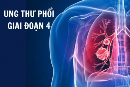 Tìm hiểu về ung thư phổi giai đoạn 4 và giải pháp thảo dược từ Tumolung