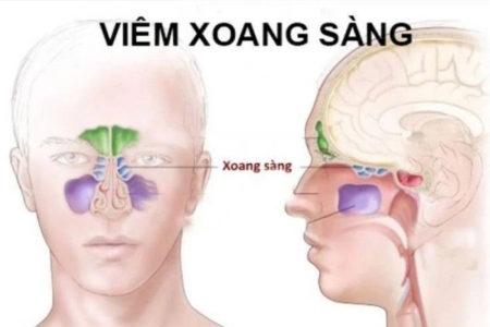 Cải thiện viêm xoang sàng hiệu quả tại nhà nhờ Xịt mũi họng Khiết Thanh