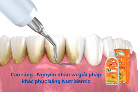 Cao răng - Nguyên nhân và giải pháp khắc phục bằng Nutridentiz