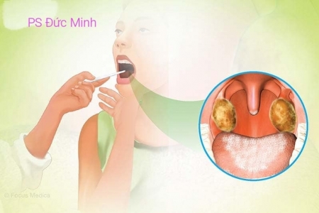 Vĩnh Phúc tăng cường công tác phòng, chống bệnh bạch hầu