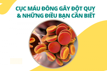 Cục máu đông gây đột quỵ và những điều bạn cần biết