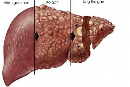 Viêm gan B - Kẻ thù thầm lặng cần luôn đề phòng